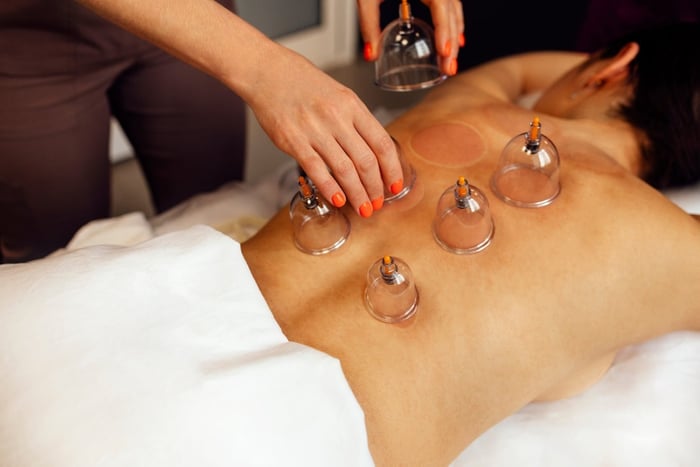 30-Minute Dry Cupping Therapy image